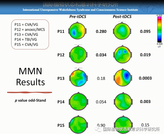Oded Meiron & Lior Molcho：靶向前额叶的tDCS结合单通道EEG监控系统研究-千蝶医学
